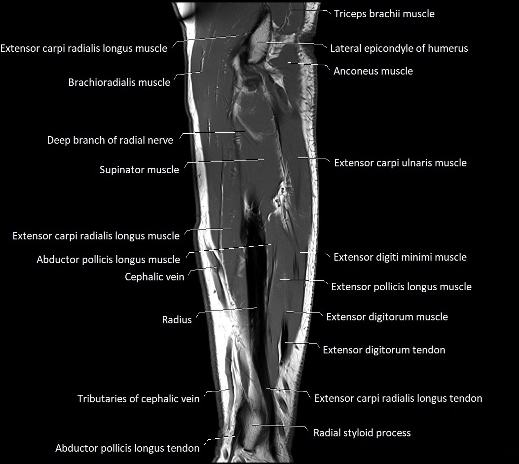 MRI 3T forearm sagittal labelled cross sectional anatomy image 14.webp